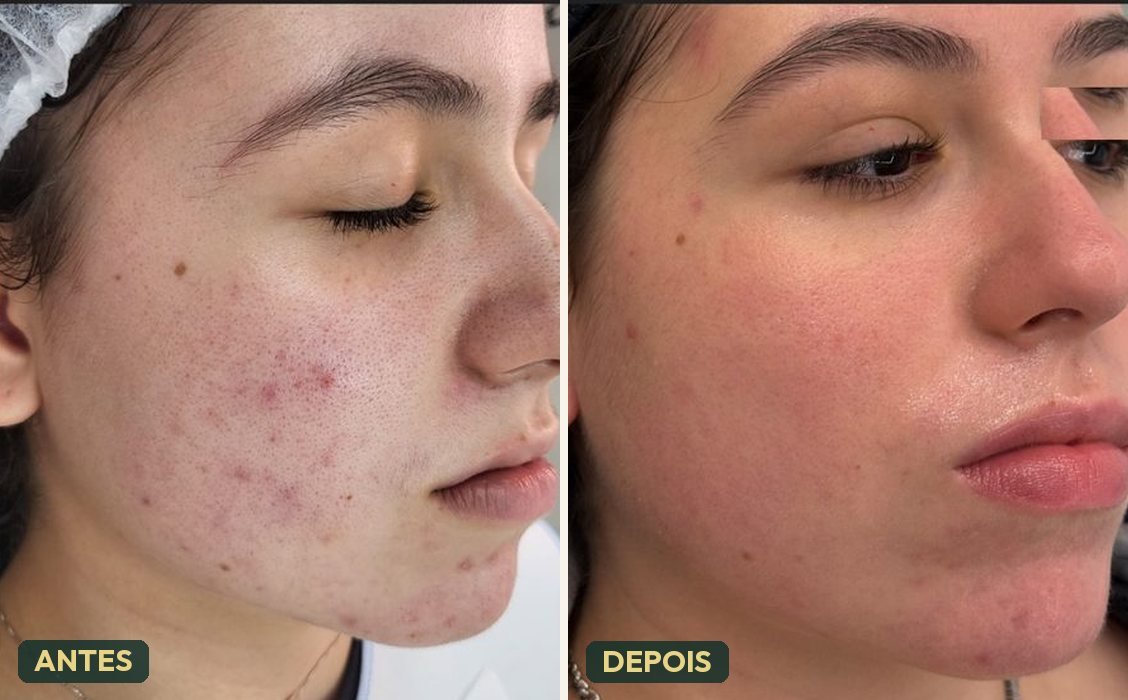 Antes e depois de tratamento para pele com acne — melhora de lesões e textura
