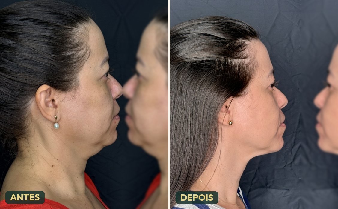 Antes e depois de harmonização do contorno facial em perfil — definição de mandíbula e pescoço