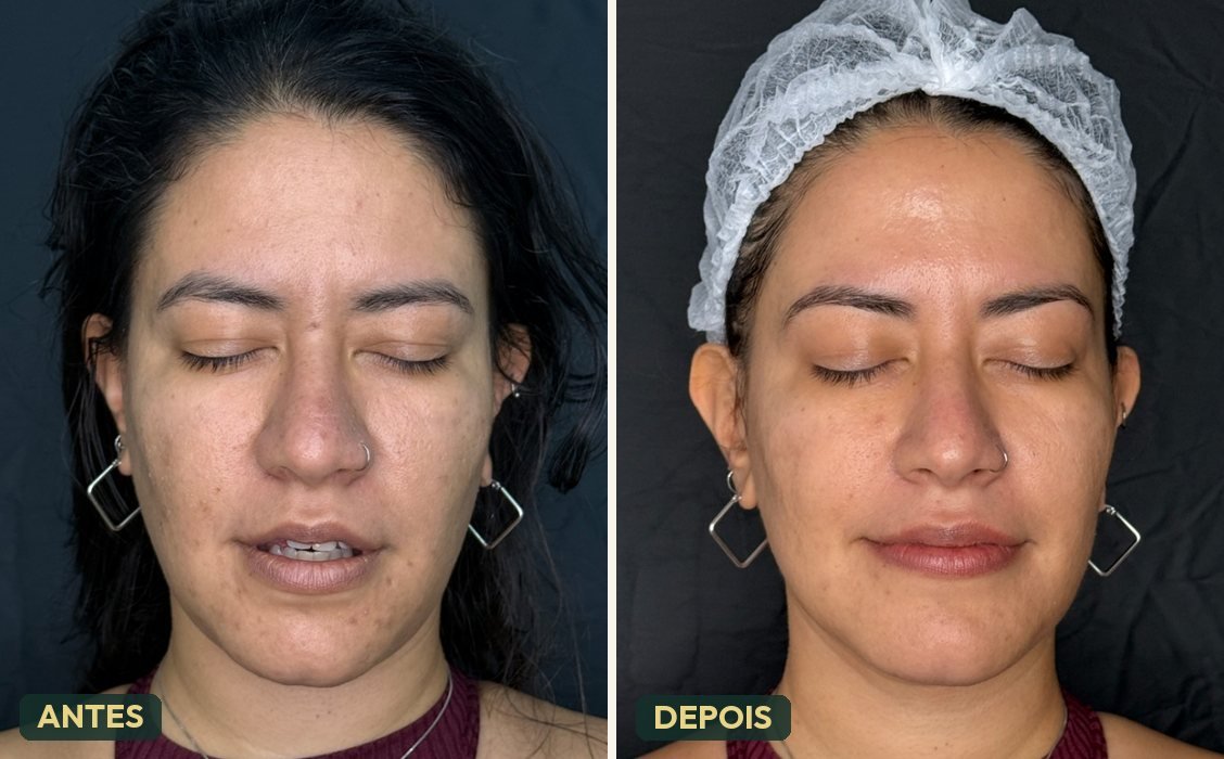 Antes e depois de protocolo de qualidade de pele — rosto mais uniforme e luminoso