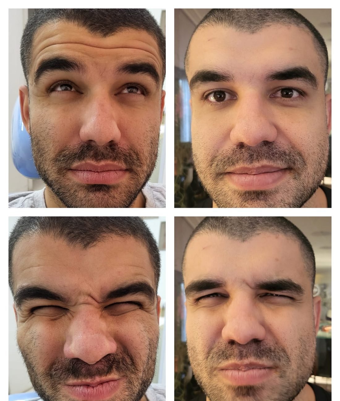 Antes e depois de toxina botulínica em paciente homem, região da glabela e testa