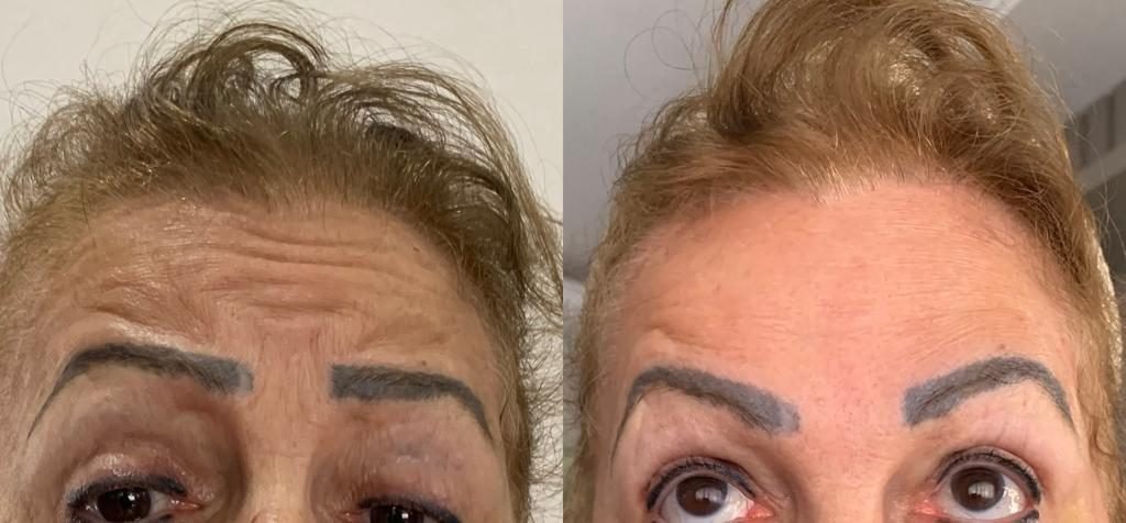 Toxina botulínica: antes e depois