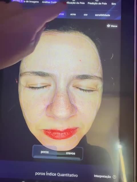 Identificação de lesões de acne no rosto